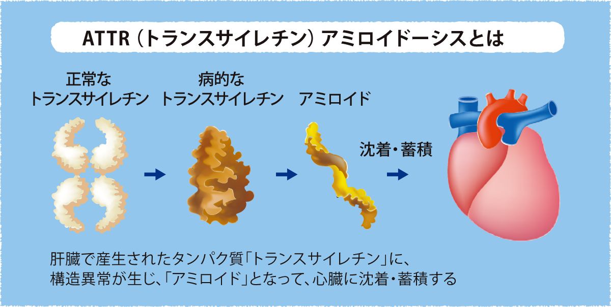 ATTR（トランスサイレチレン）アミロイドーシスとは（図）