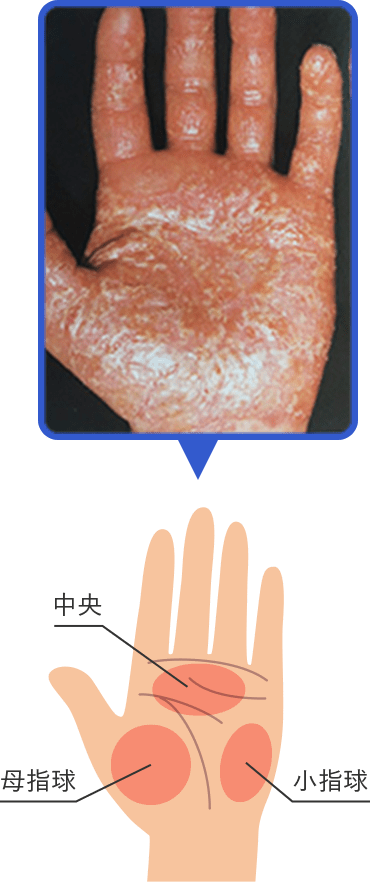 症状:手のひら